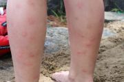 To Do List....Buy Bug Spray (Greg Sladics)